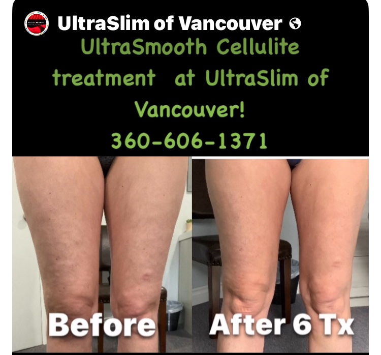 UltraSlim of Vancouver project photo 8
